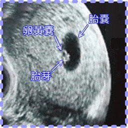 妊娠6週2日の胎嚢と胎芽の画像