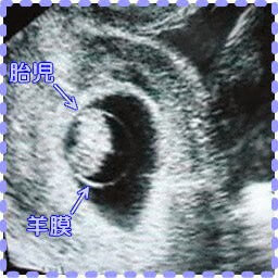 妊娠8週3日の胎児の画像