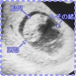 妊娠9週6日の胎児と臍帯の画像