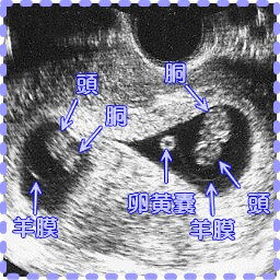 妊娠10週の双胎の胎児と卵黄嚢の画像