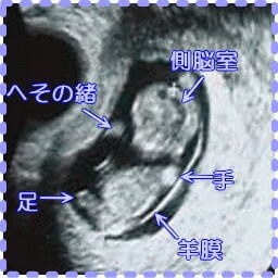 妊娠10週6日の胎児の画像