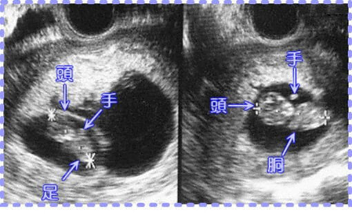 妊娠11週の双胎の胎児画像