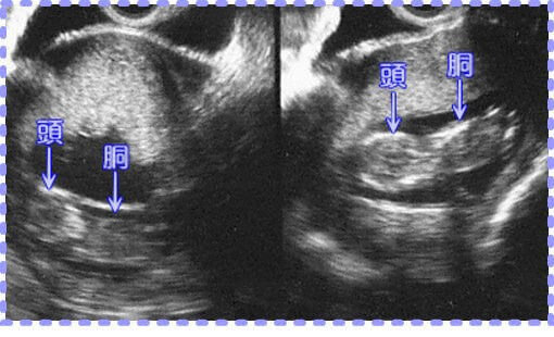 妊娠14週の双胎の胎児画像