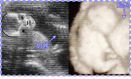 妊娠17週4日の3Dと2Dの胎児画像