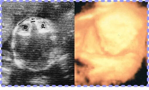 妊娠20週4日の3Dと2Dの胎児画像