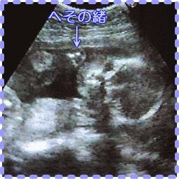 妊娠22週5日の胎児画像