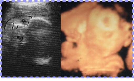 妊娠26週3日の3D・2Dの胎児画像