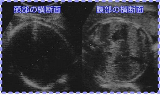妊娠32週5日の胎児画像