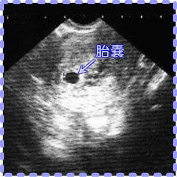 妊娠4週6日の胎嚢の画像