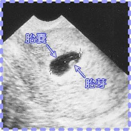 妊娠5週5日の胎芽の画像