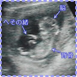 妊娠13週2日の胎児と臍帯の画像