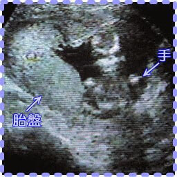 妊娠13週5日の胎児と胎盤の画像