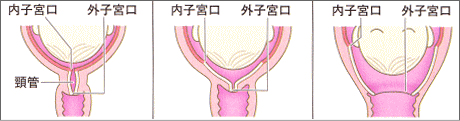 初産婦の子宮口開大